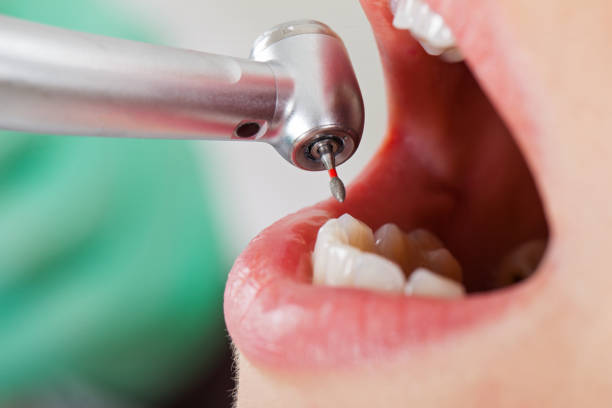 Best Dental Abscess Treatment in Rainier, WA